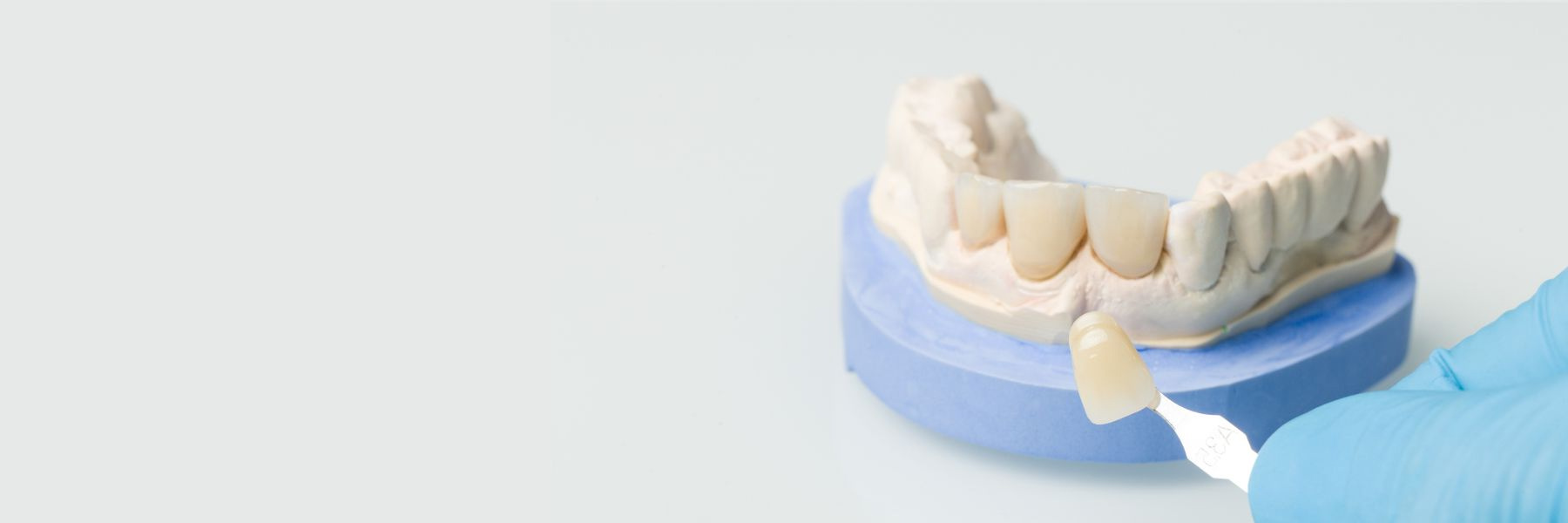 Porcelain Veneers | Dentist